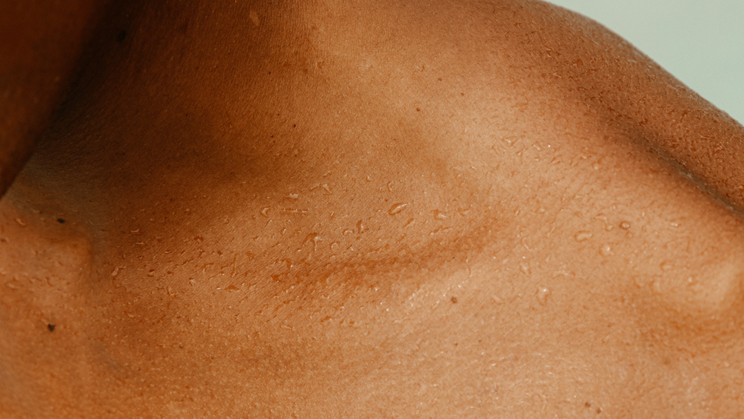 Hyperhidrosis FAQs with Dr Dawn Harper
